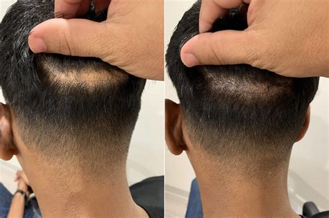 Scalp Micropigmentation in Miami 